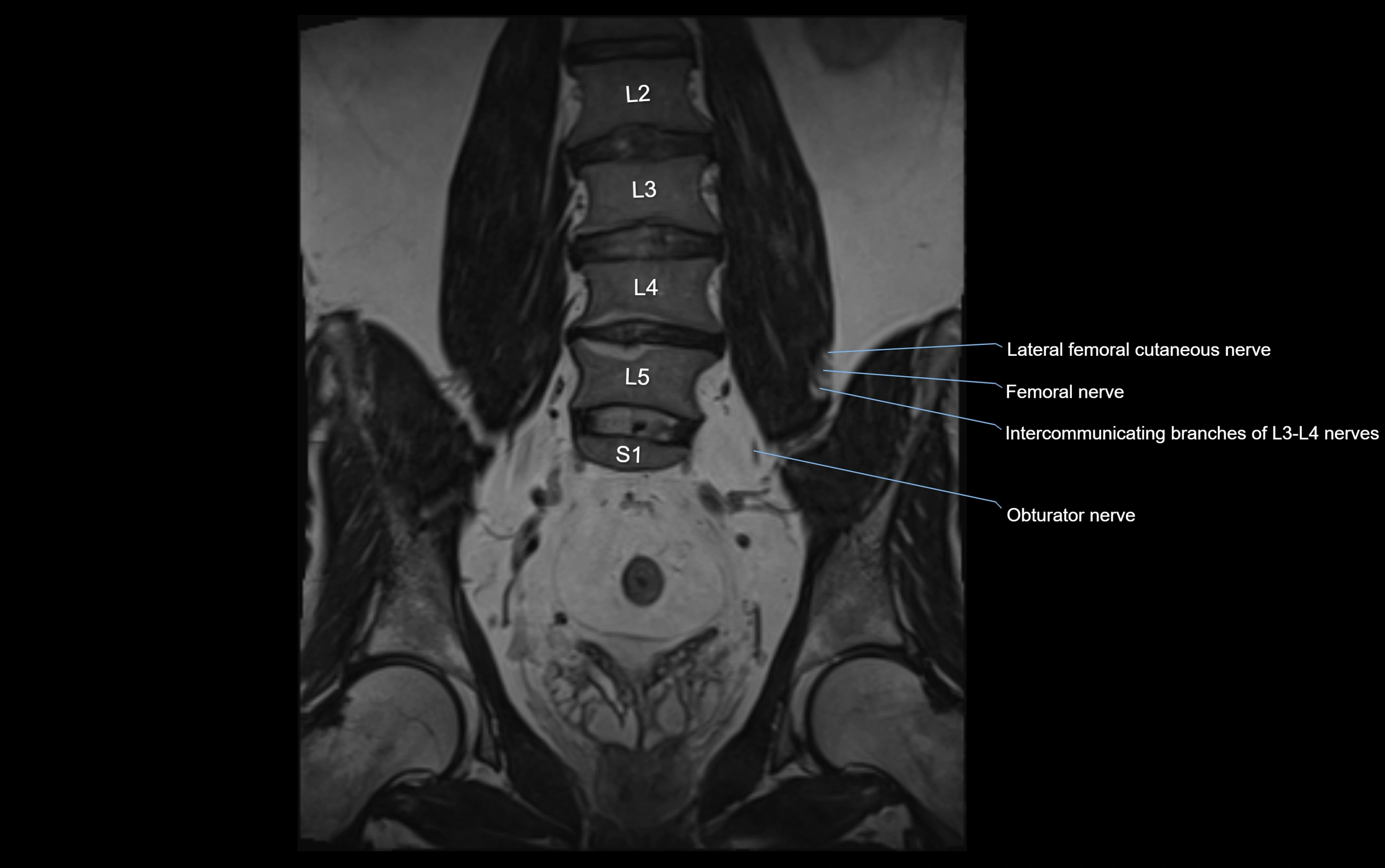 MR lumbosacral plexus cross sectional anatomy 3T  radiology  image-img-09001-00028.webp